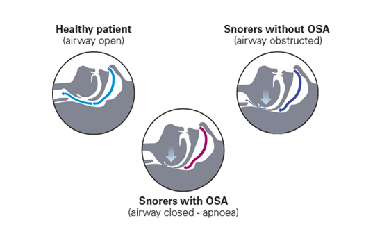 the-airway-when-you-snore-apnoea