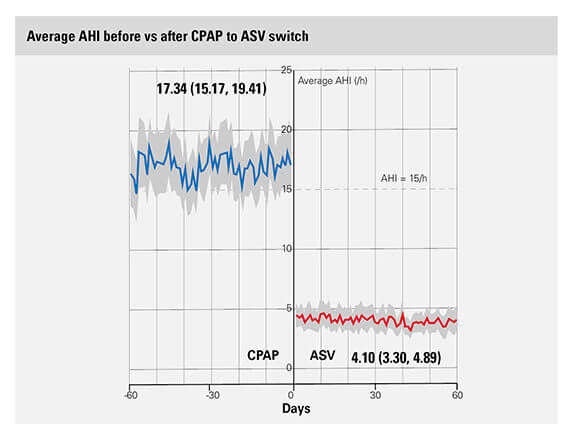 big-data-ASV-switch-AHI-ResMed